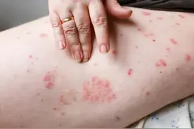 带状疱疹、湿疹，用什么药好得快？常见皮肤病「用药指南」来了图片