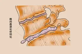 106种疾病和缺钙有关！骨质流失的“凶手”，或许是错误饮食图片