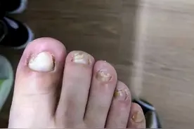 学会这3个小方法，在家轻松摆脱灰指甲！图片