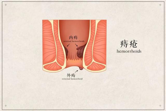 喝酒后痔疮犯了怎么办