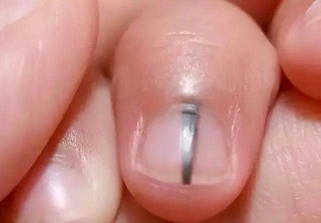 孩子指甲这4种表现是患病信号！第1种可能预示肿瘤