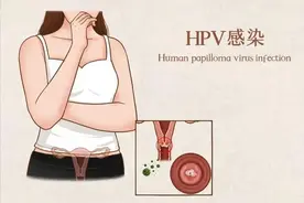 感染HPV的人，有这5种特征。图片