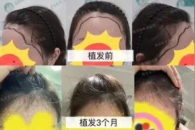 植发手术3个月，能恢复成什么样子？图片