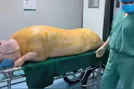女孩患上罕见怪病，最终医生决定用猪皮来移植，父母心痛不已图片