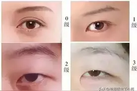 16岁，想做韩式三点双眼皮？需要开眼角吗？整形医生丁小邦解答图片