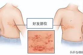 警惕！福州男子带状疱疹长腿上，医生刨根究底查出源头竟是结肠癌图片