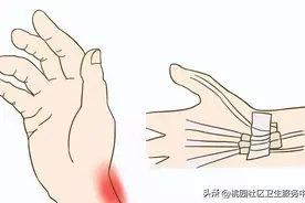 当心手腕疼！1个动作自测“腱鞘炎”！6个动作快速摆脱它！图片