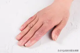 皮肤科医生和你聊聊：冻疮有哪些防治要点？图片