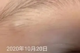 孩子面部皮脂腺囊肿图片