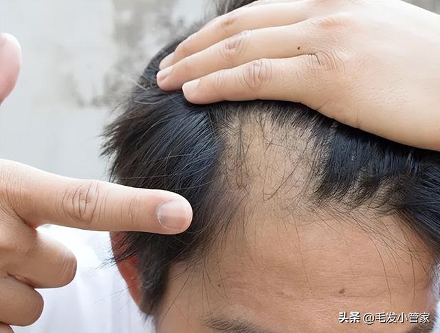 用这几个方法，让你的发际线不再后移