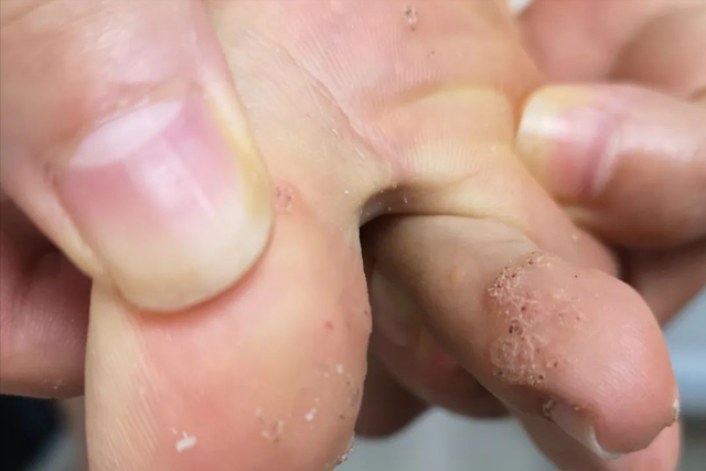 角化棘皮瘤的病理要点