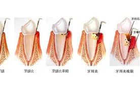 有什么方法可以治疗松动的牙齿？图片