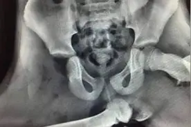 可怕，英女子坐副驾翘脚，安全气囊以200km/h爆开，股骨插进屁股图片