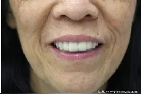 缺牙别再戴挂钩假牙了，新型无挂钩义齿不伤健康牙图片