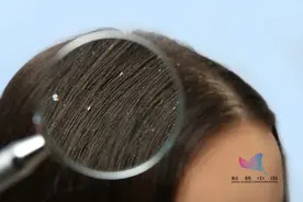 头皮屑很多，究竟怎么办？皮肤科医生告诉你这些干货图片