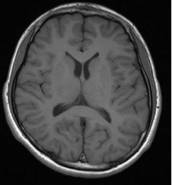左旋多巴联合盐酸普拉克索药物方案，控制帕金森病