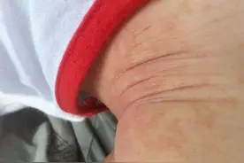 0～1岁小婴儿常见皮肤疾病及处理方法图片