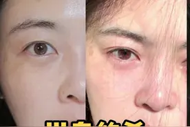 我的双眼皮真的不是做的视频封面