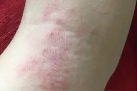 皮疹越抓越厚 这可不是湿疹！别乱挠 可以这样处理#希望...图片
