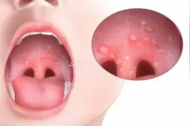 高能预警！疱疹性咽峡炎又双叒叕来了！图片