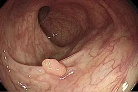 结肠息肉是什么原因导致的，发现肠息肉要怎么治疗？图片