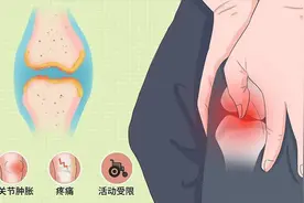 滑膜炎要怎么处理？治疗护理几步走，恢复得更快图片