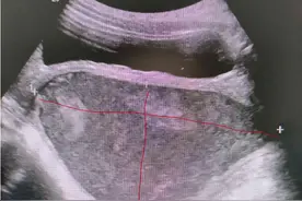 福州11岁女孩反复腹痛尿不出，没想到是“青春期”惹的祸图片