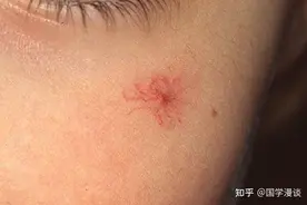 为什么皮肤上会长红色小点？这种“血管痣”是疾病的信号吗？图片