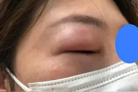 虫咬皮炎（丘疹性荨麻疹）图片