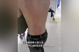 男大学生被女同学喷不明液体，导致二度烧伤，学校称双方已和解，网友：换成男的100%开除图片