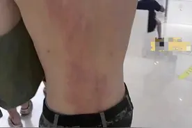 男大学生被女同学喷不明液体，导致二度烧伤，学校称双方已和解，网友：换成男的100%开除图片
