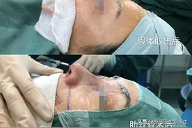 “修复难，难于上青天”隆鼻失败的那些求美者该怎么办？一文全解图片