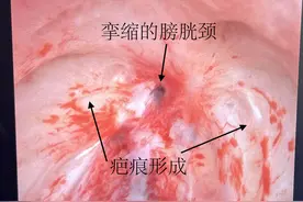 前列腺增生手术并发症之膀胱颈挛缩，一个病例彻底了解这个问题图片