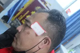 郑州市第二中医院：疤痕色素沉着怎么去除？图片