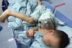 六岁男孩被鞭炮炸断胳膊，医生详解救治过程图片