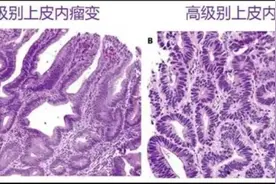 低级别上皮内瘤变是癌吗？图片