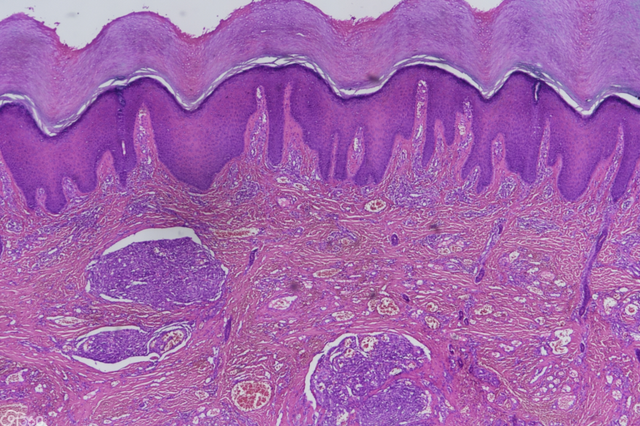宝宝口腔白色角化株