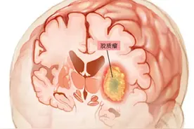 凶险的脑胶质瘤，到底如何对付？图片