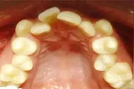 为了矫正牙齿而拔牙值得吗？看完这篇文章我悟了！图片