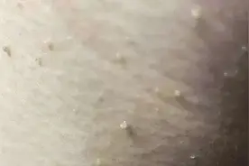 小伙脖子长出很多“小肉揪”竟是HPV感染图片