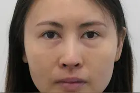 苏35岁沈女士到京修复鼻子、填泪沟，术后10天却说自己不敢认图片