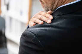 头皮屑像小雪片一样？可能是一些疾病状态了！三点建议助你去除或减少头屑图片