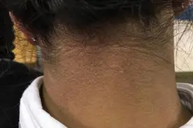 脖子上一圈黑黑的，怎么洗都洗不干净，这是怎么回事图片