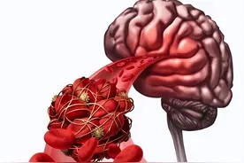 得了多发性脑梗死，严重吗？医生告诉你怎么预防治疗图片