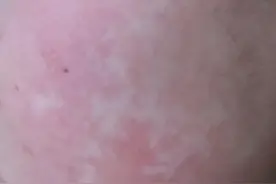白癜风白斑部位变红是怎么回事？图片