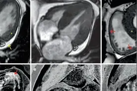 心脏磁共振典型病例集锦图片
