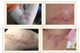 烧烫伤疤痕的两个最佳治疗时期！千万不要错过图片