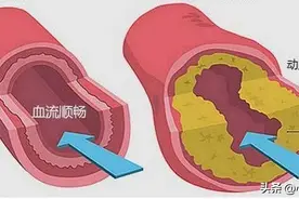 血脂正常了，可以停药吗？图片