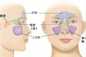 【揭秘鼻窦炎】了解鼻窦炎的症状及表现,及时摆脱鼻窦炎困扰！图片