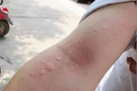 孩子被毛毛虫蛰伤，妈妈3招处理救了娃，医生：很高明图片